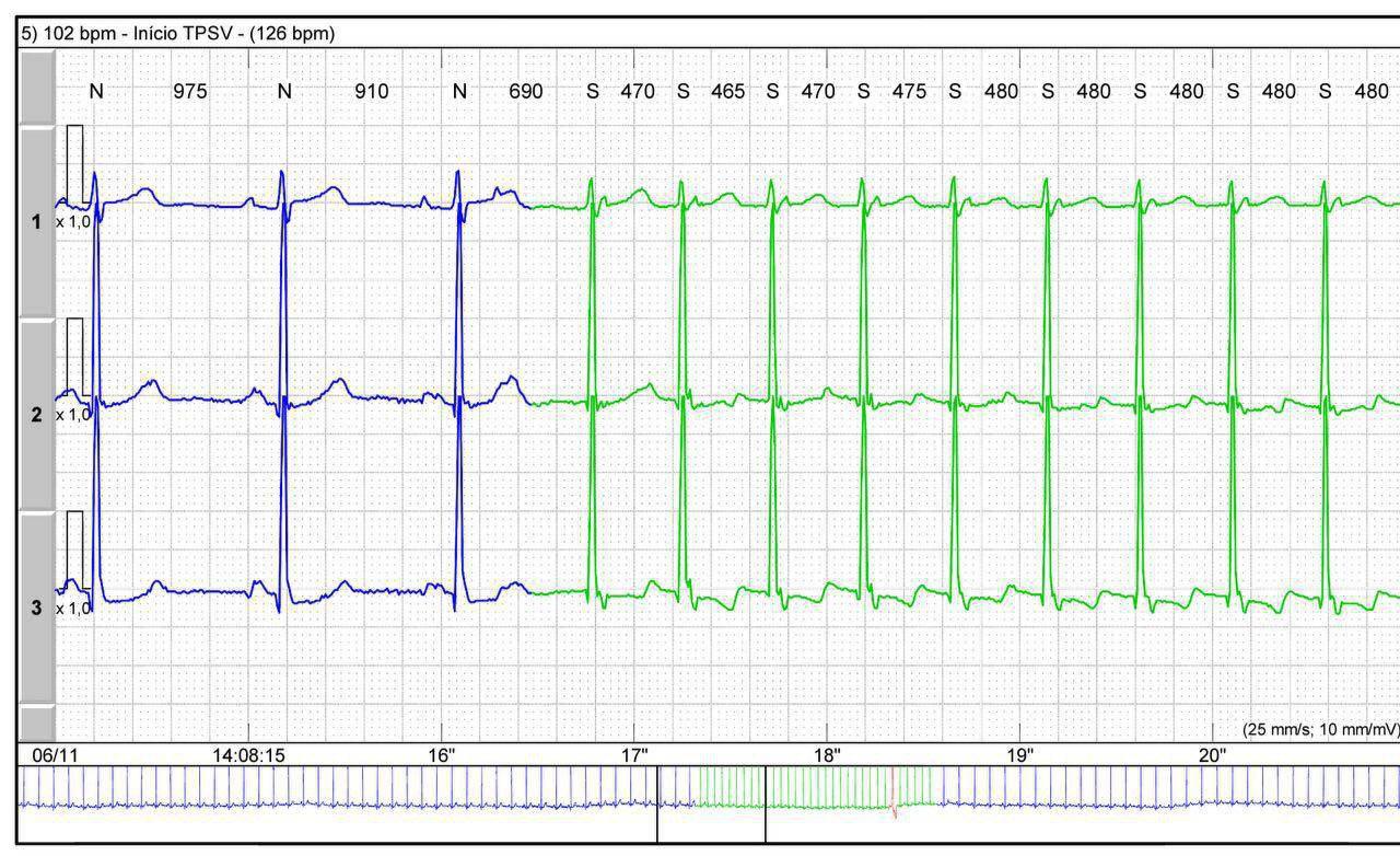 Holter de mujer joven con Taquicardia intranodal
