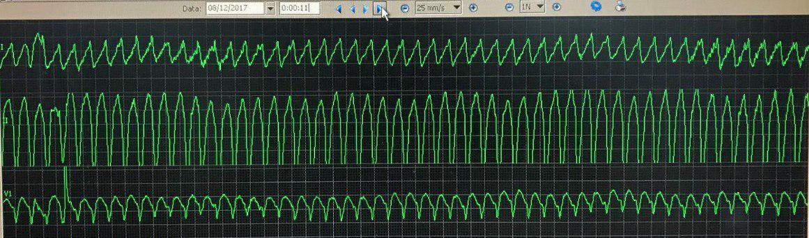 Post angioplastia de CD por SCA e implante de MP transitorio luego de CVE
