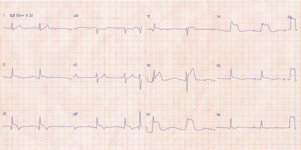 Mujer de 52 años con angor prolongado por oclusión de dos stens implantados la semana previa por abandono del clopidogrel que evoluciona con TV y óbito