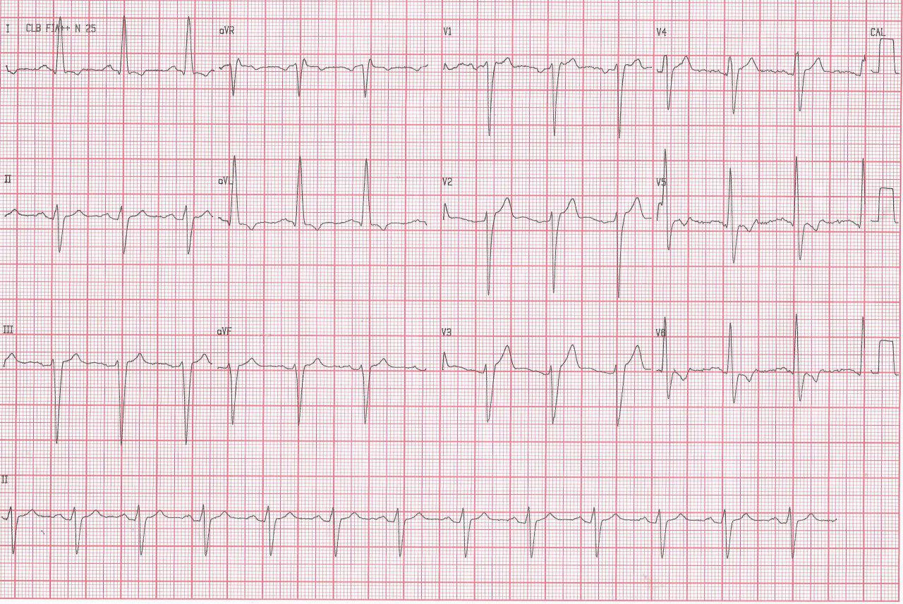 Paciente de 48 años portador de bioprótesis aórtica que cursa endocarditis infecciosa con abseso que determina BAV y es extirpado exitosamente