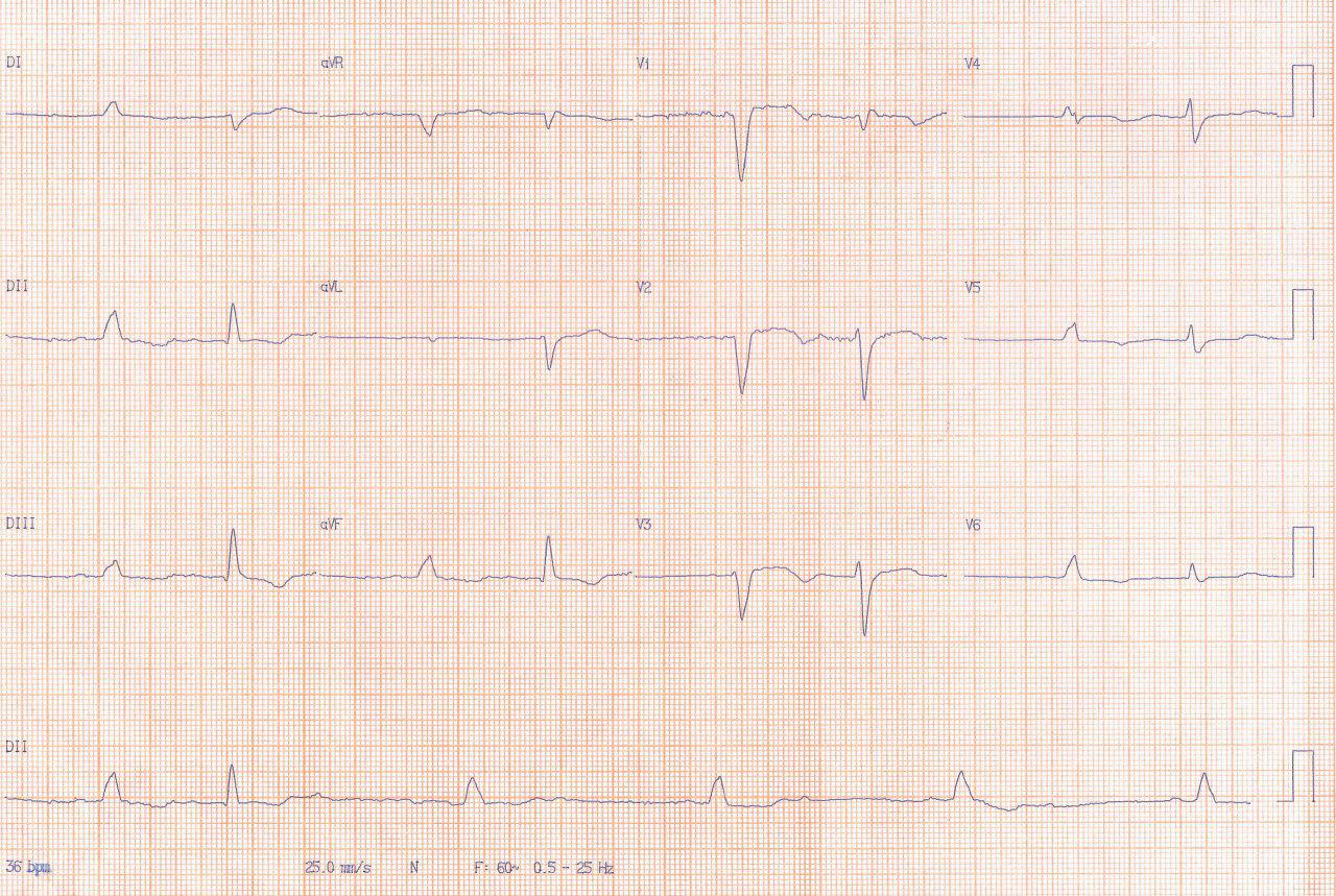 Mujer de 76 años con episodio sincopal con severos trastornos de conducción que se corrigen al detectarse hipotiroidismo y realizar terapia sustitutiva