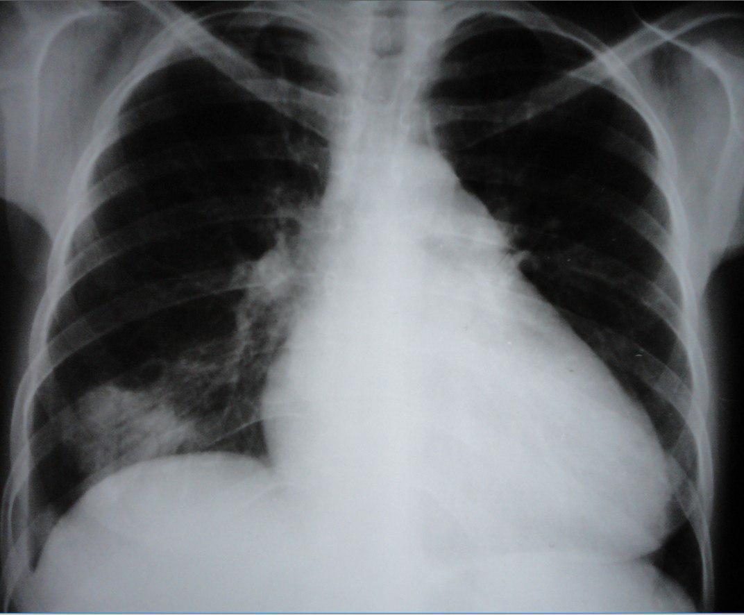 Mujer de 35 años portadora de insuficiencia cardíaca que presenta cuadro de TEP e infarto pulmonar