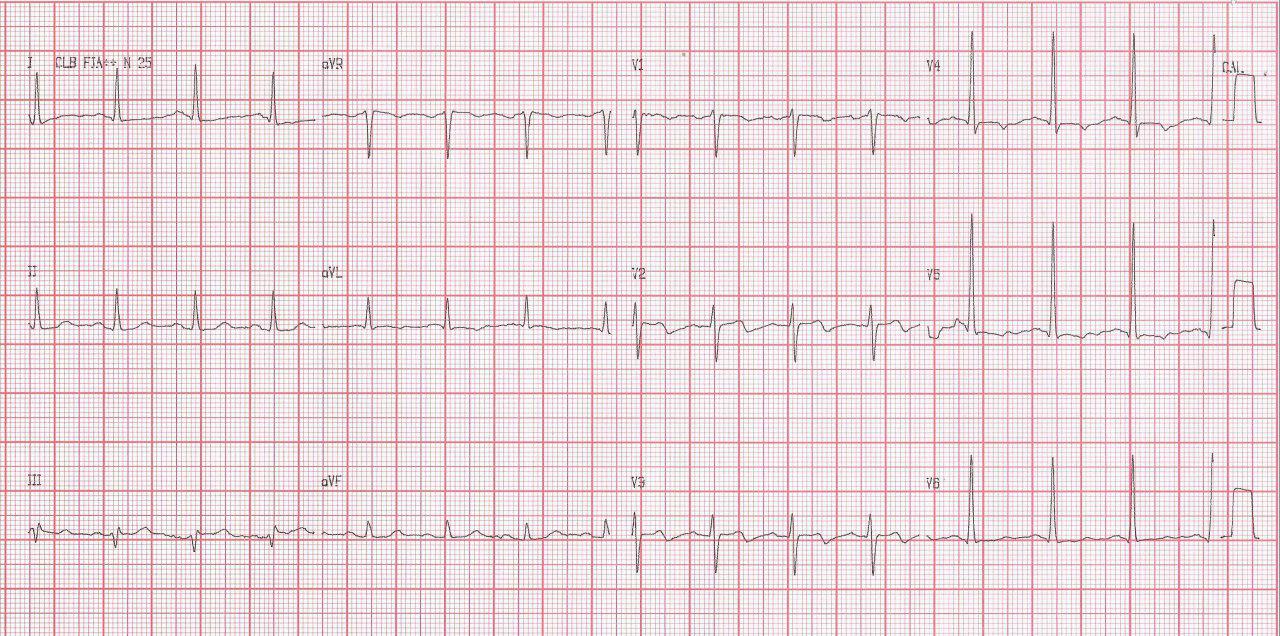 Mujer de 85 años con factores de riesgo presenta episodios de angor subintrante con elevación de troponina por IAMSEST debido a suboclusión proximal de la DA