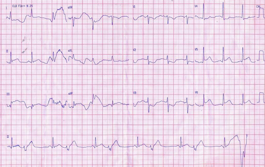 SCA en mujer de 65 años por compromiso de CD que presenta FV y es revertida