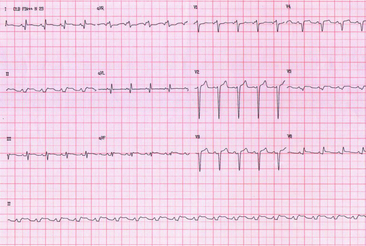 Mujer de 41 años con antecedente de cirugía de by pass presenta SCA por obstrucción de puente de Cx y desarrollo de infarto de cara lateral e infarto de aurícula