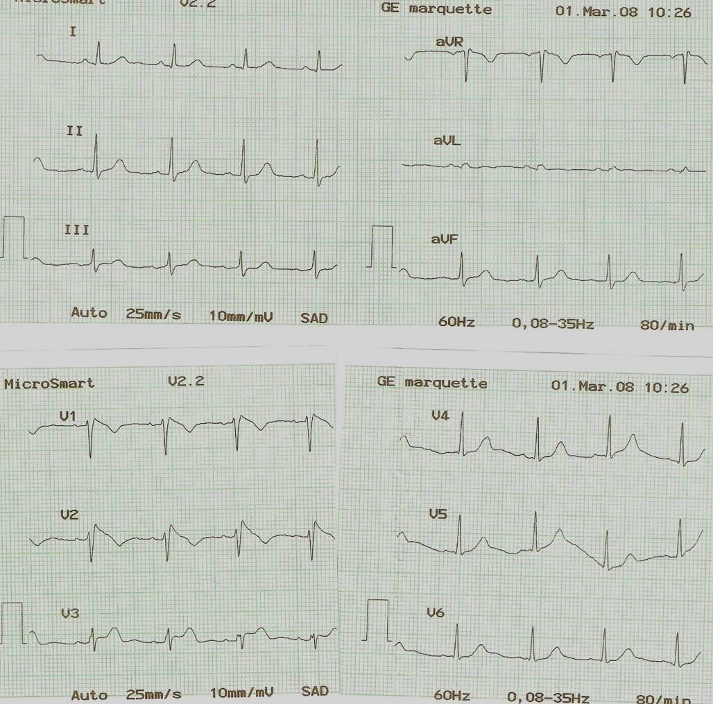 Mujer de 41 años con episodio sincopal por Síndrome de Brugada