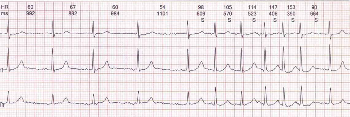 Anciano con antecedente de ACV y Síndrome de Bayés en el que se muestra la onda P característica en VI predictora de FA paroxística, introducida por Morris en 1964