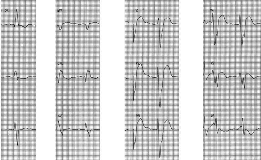 Paciente de 68 años con cuadro de ICC y antecedente sincopal por infarto crónico de cara anterior