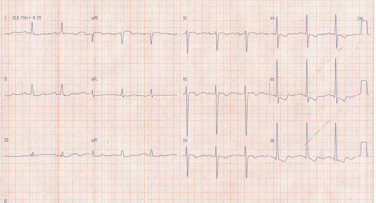 Mujer de 54 años hipertensa no controlada que presenta soplo de regurgitación aórtica por rara disección indolora