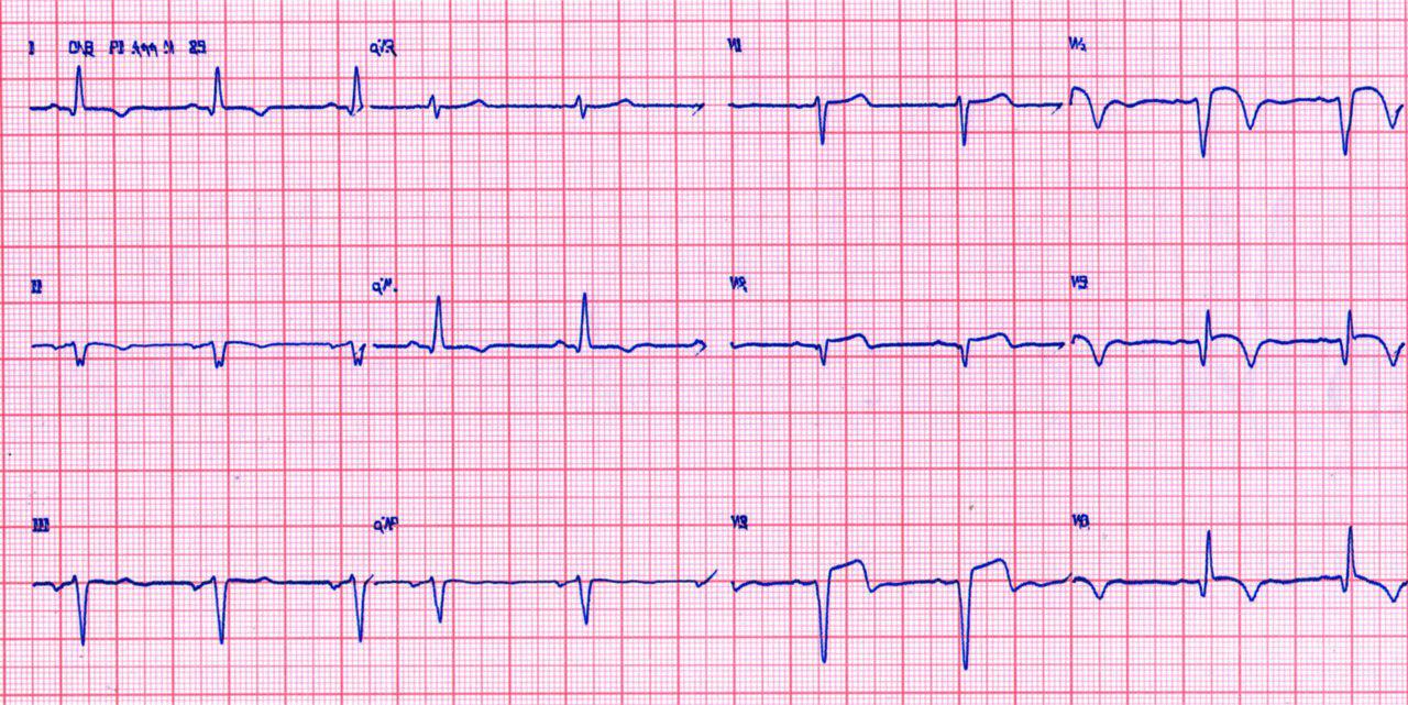 Paciente con antecedentes de infarto no reperfundido hace dos años que cursa con angor y disnea
