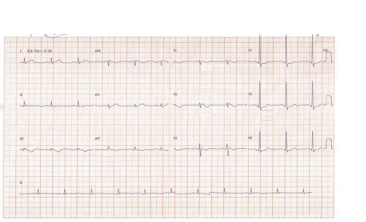 Paciente de 51 años con fenocopia de Brugada por hernia de hiato y esofagitis