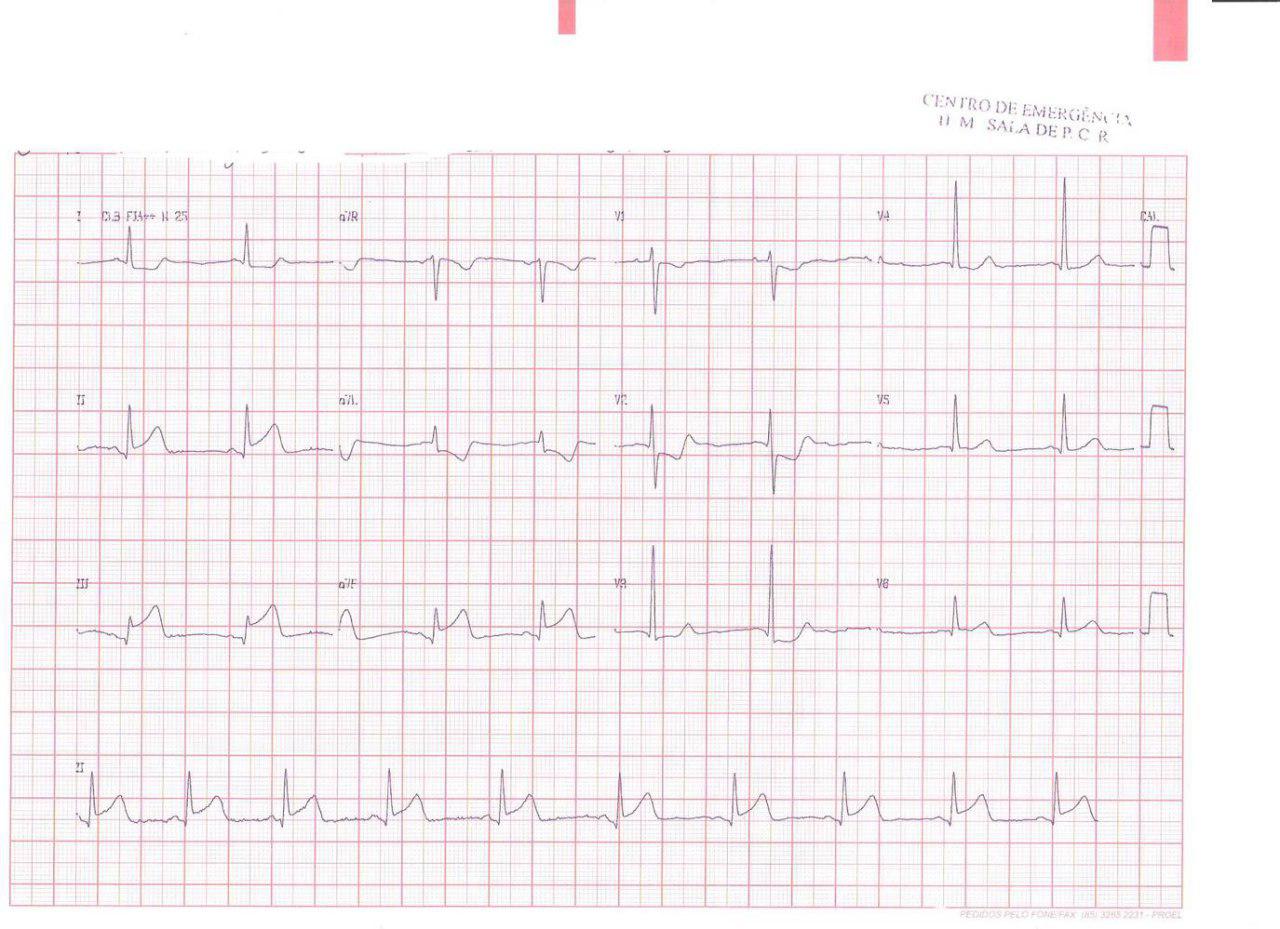Paciente de 43 años consumidor de cocaína que presenta angor prolongado y paro cardíaco con CCG con arterias coronarias normales