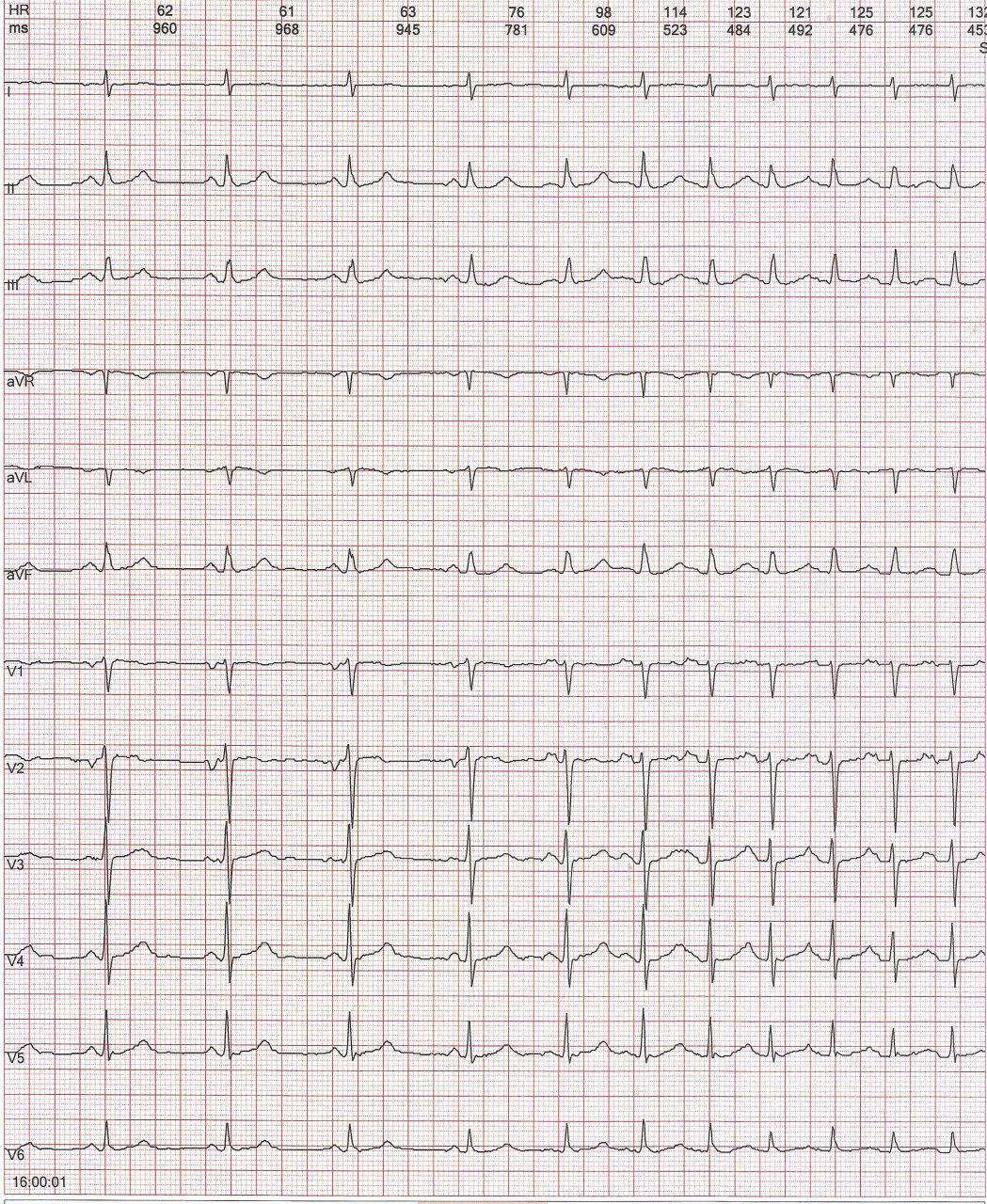 Taquicardia auricular automática por calentamiento del foco