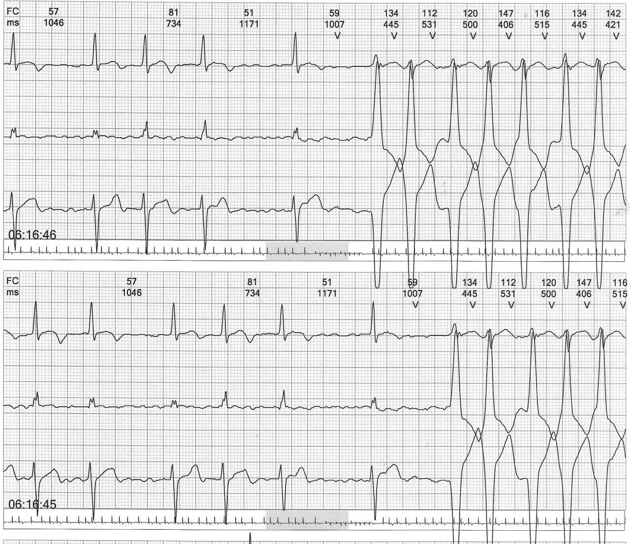 Paciente de 83 años hipertenso y diabético que presenta FA con aberrancia en fase 3 y fase 4