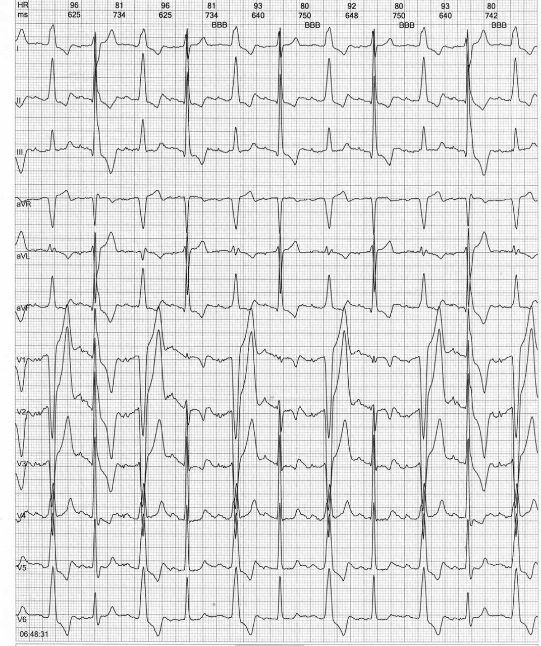 Episodio sincopal por presencia de bloqueo de rama bilateral