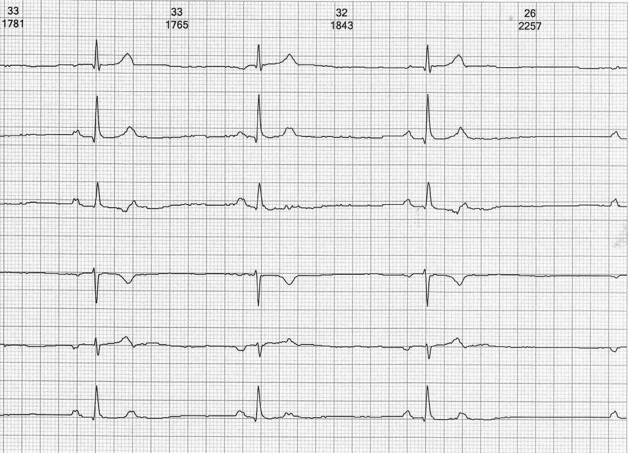 Paciente de 55 años con apnea del sueño que presenta bradicardia por extrasistolia auricular bloqueda y bigeminada