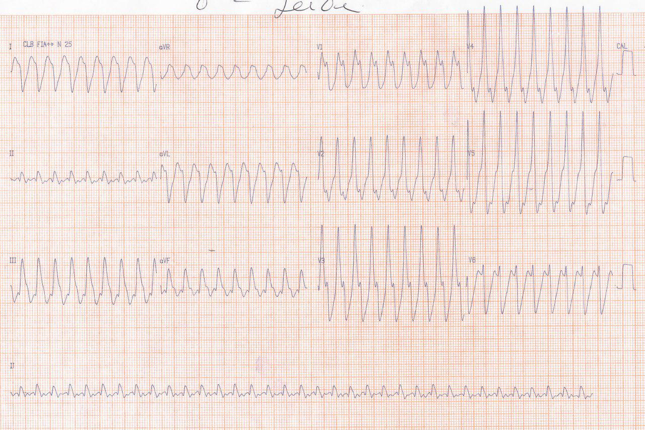 Paciente de 75 años con CRV en 2015 con 21% de Fey presenta TV que revierte con amodarona