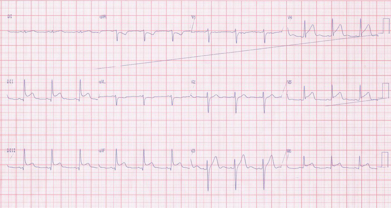 Paciente de 24 años con angor prolongado y coronarias normales por miocarditis aguda