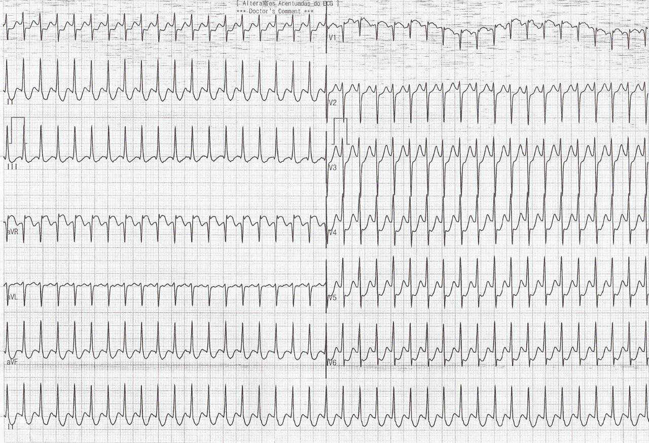 Mujer joven con palpitaciones taquicárdicas por reentrada intranodal