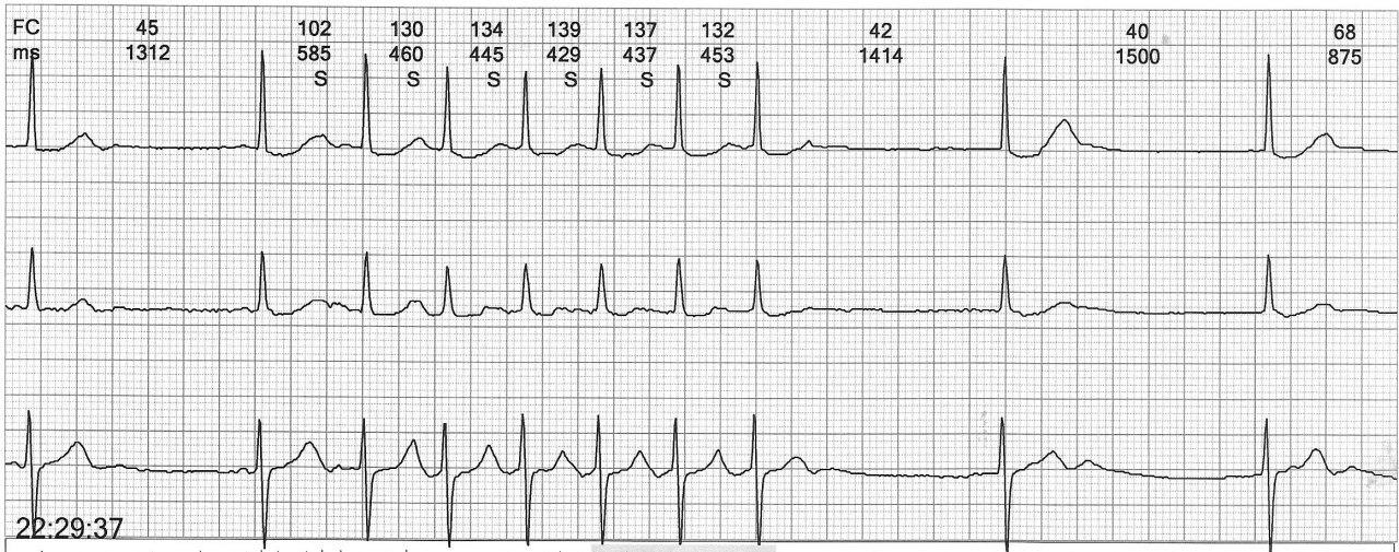 Paciente de 79 años portador de síndrome «bradi – taqui» en uso de amiodarona y bisoprolol que presenta mareos