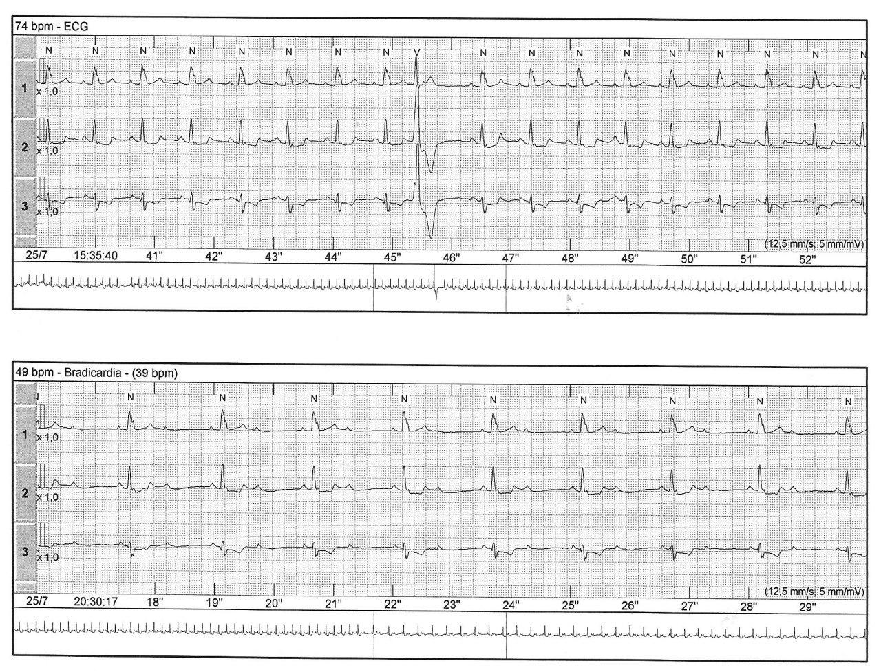 Holter de paciente que presenta episodio sincopal que muestra BAV que por momentos es Mobitz 1 y en otros Mobitz 2 con QRS anchos infrahisianos