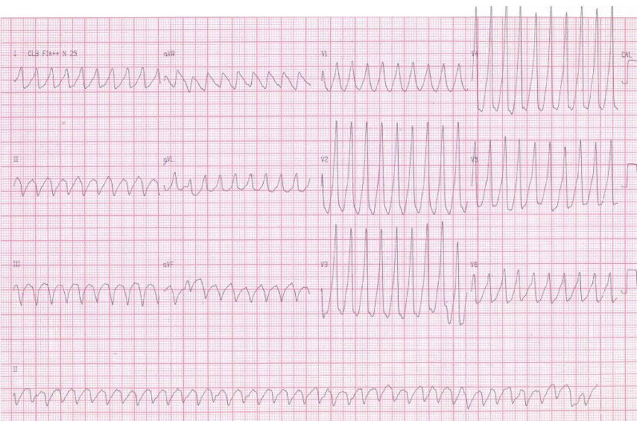 Paciente de 62 años con serología reactiva para enfermedad de Chagas presenta episodio sincopal por TV que requiere CVE