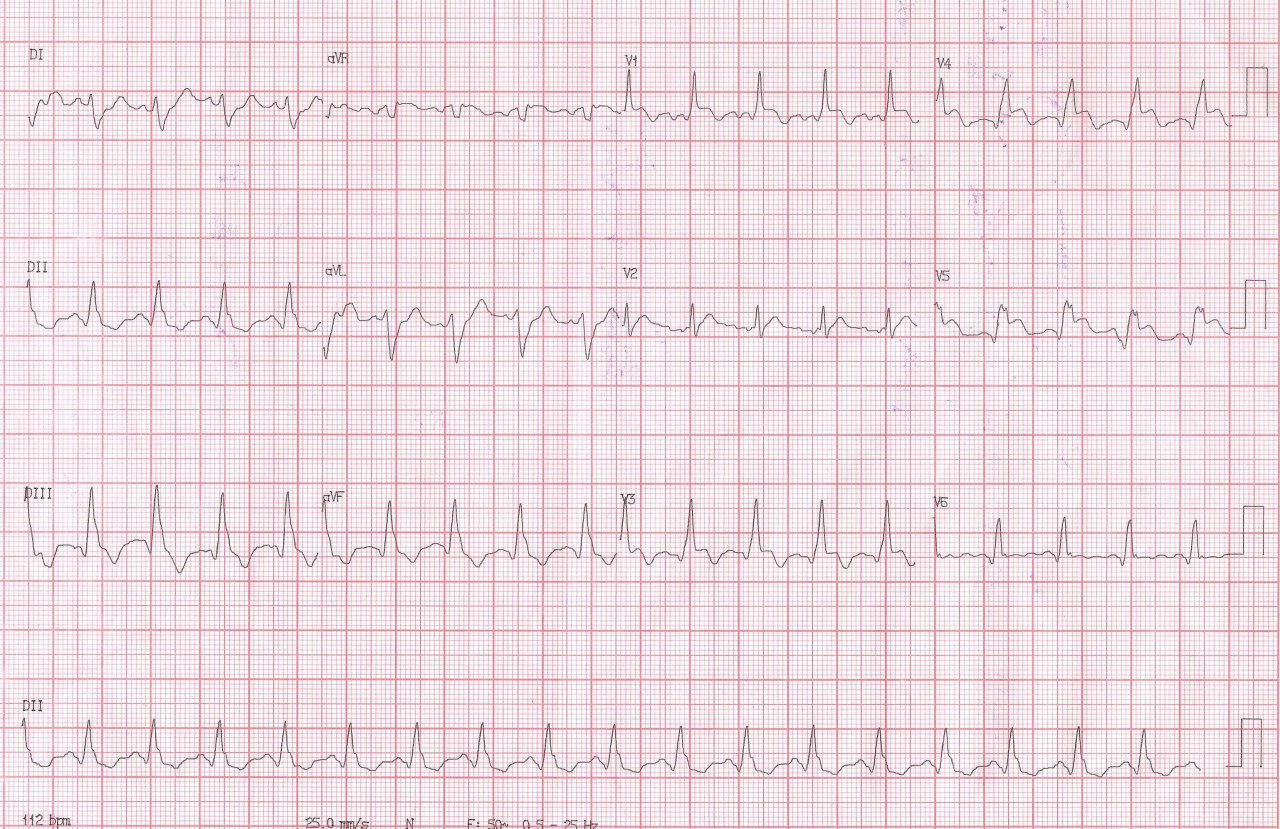 Masculino de 70 años con FR y angor prolongado por SCA por oclusión de DA que se angioplastia con mala evolución