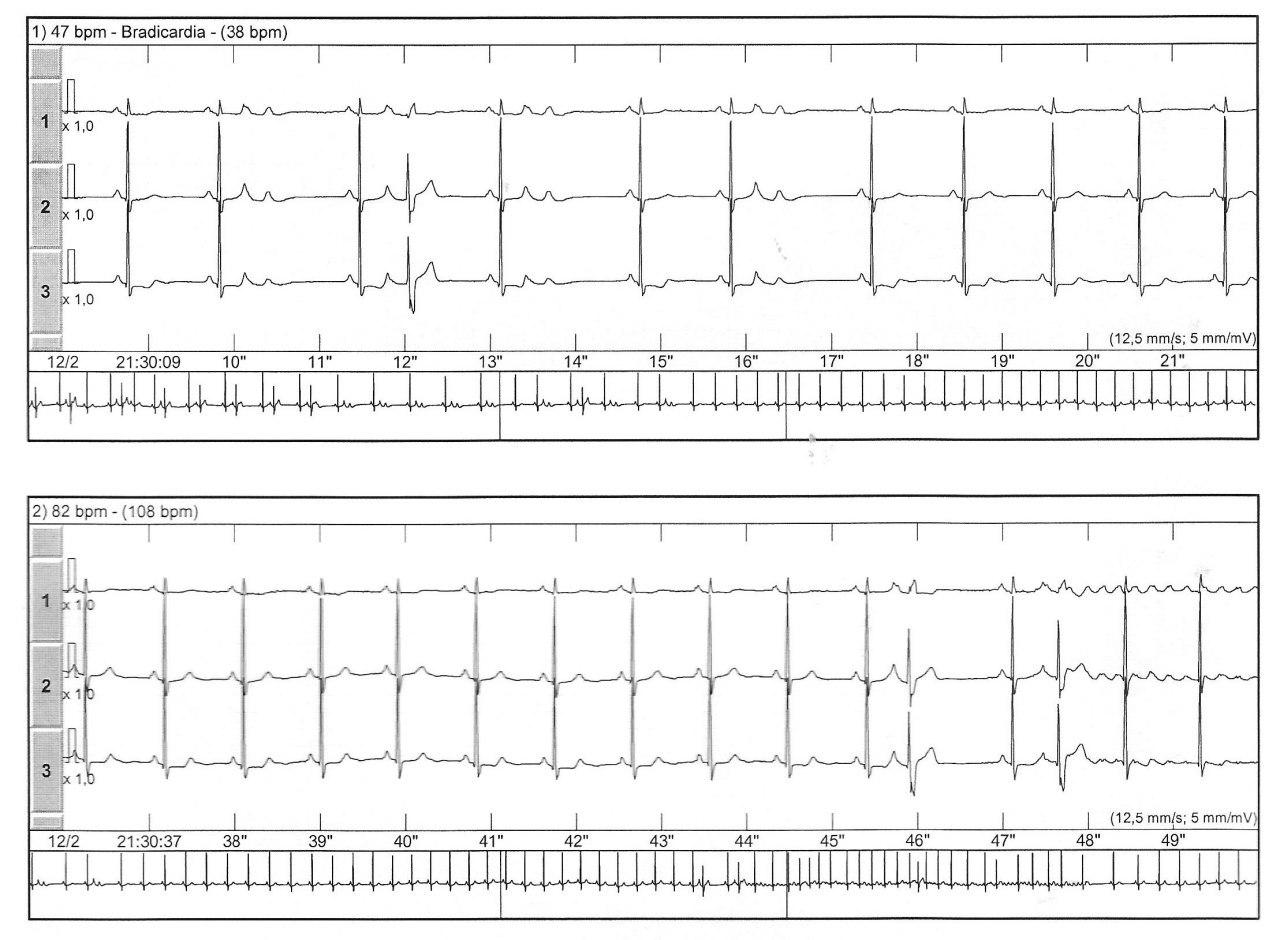 Holter de anciano con palpitaciones y déficit cognitivo por probables microembolias a partir de aleteo auricular