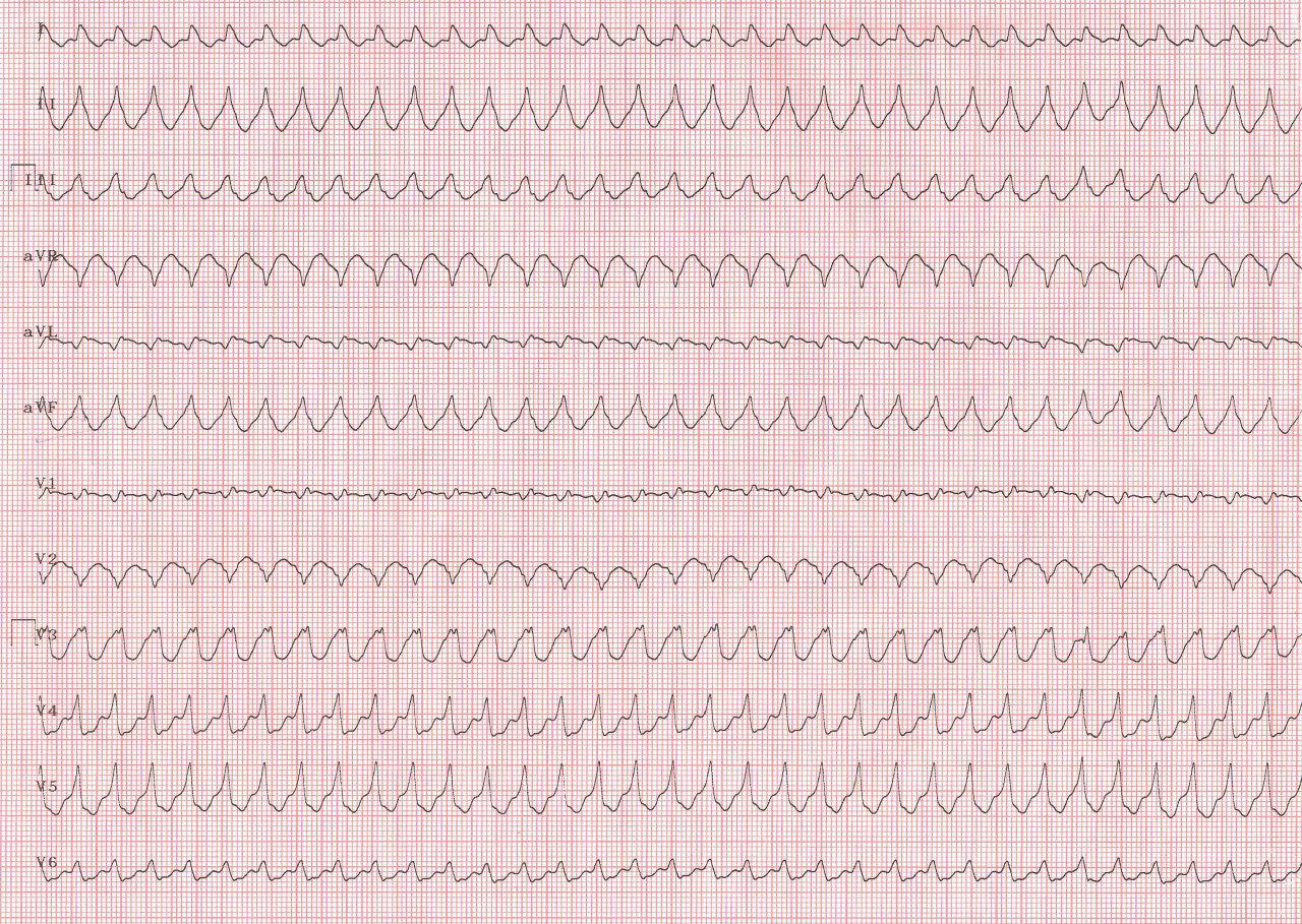 Paciente de 75 años con antecedentes de ACV que presenta FA de muy alta frecuencia con aberrancia que es frenada con adenosina