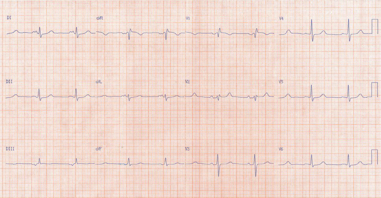 Mujer de 32 años portadora de estenosis mitral que presenta cuadro de hemiparesia izquierda y disartria