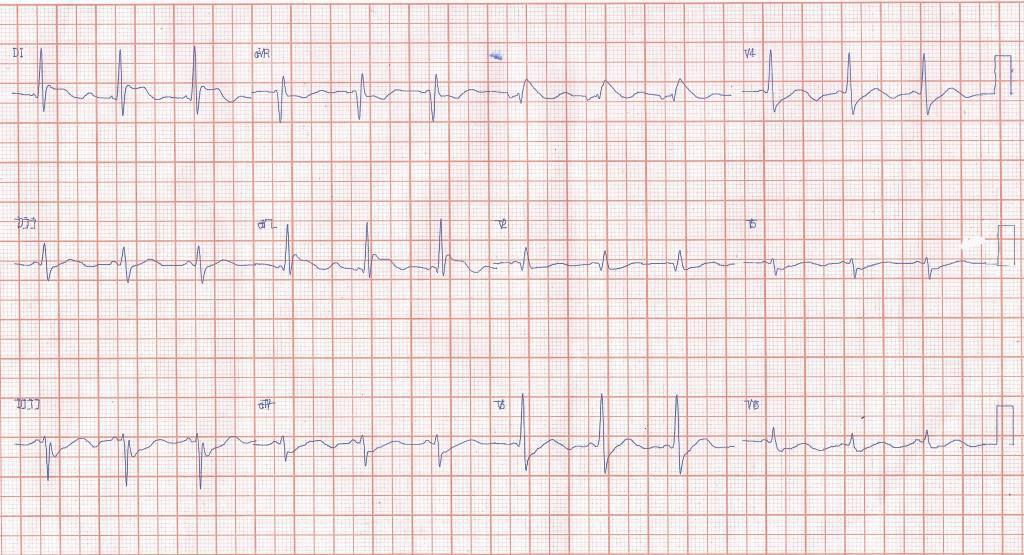 Paciente que a posteriori de inducción anestésica con propofol desarrolla episodio de FA detectándose patrón Brugada tipo I