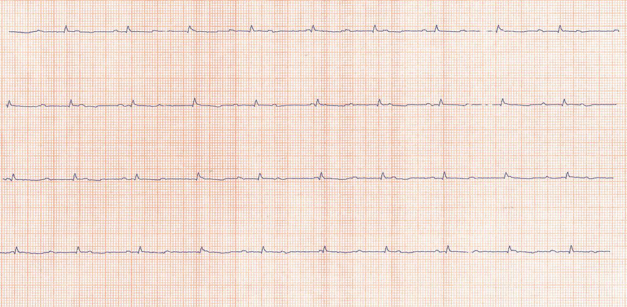 Marcapasos transitorio VVI con fallas de sensado y captura en el PO de cirugía de reemplazo de válvula mitral