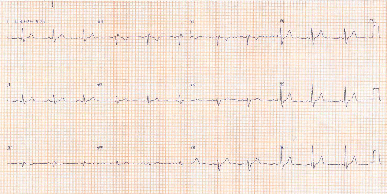Paciente de 40 años portador de CIA ostium secundum con disnea y palpitaciones