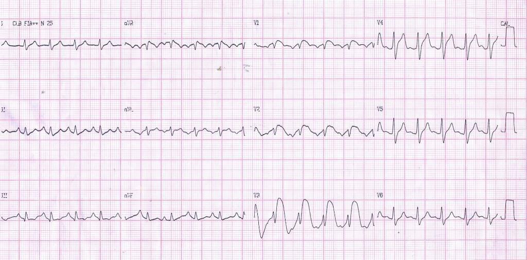 ECG típico de SVD en enfisema de un paciente con hiperpotasemia y acidosis respiratoria dando un patrón de Fenocopia de Brugada, que se corrigen