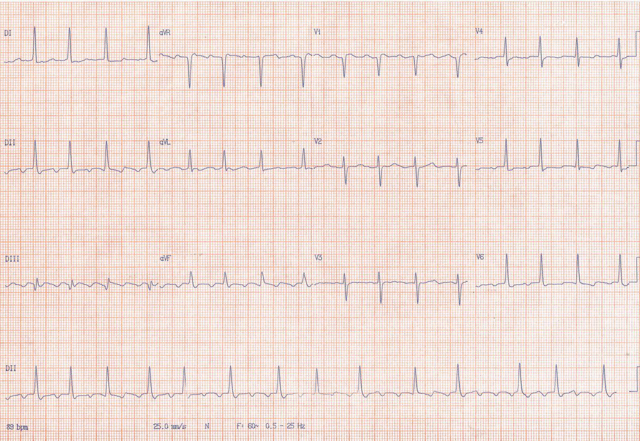 Mujer de 56 años hipertensa con antecedentes de CIA corregida con dolor nocturno y PEG + para isquemia con síndrome bradi -taqui