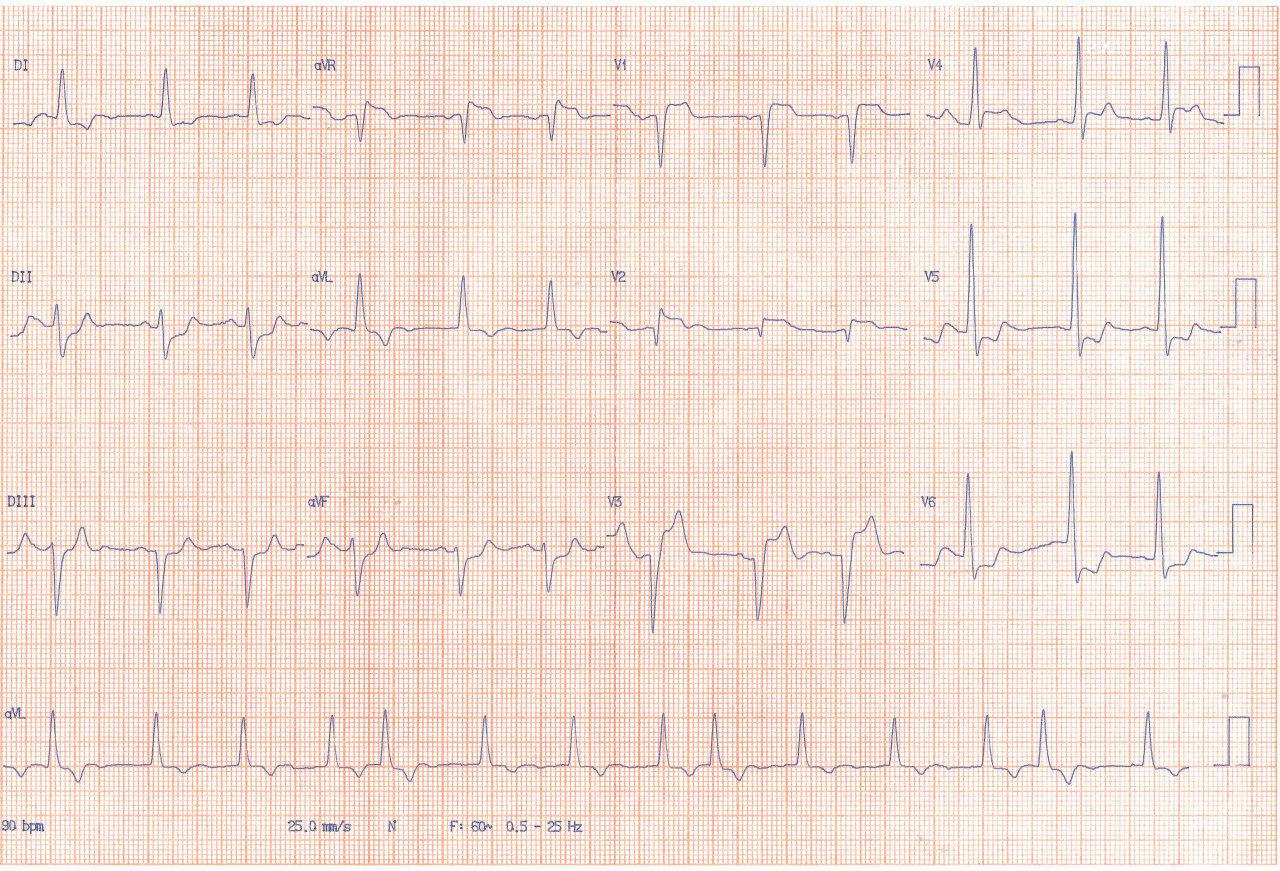Paciente de 79 años con angor progresivo por lesión de TCI y DA proximal que son angioplastiadas