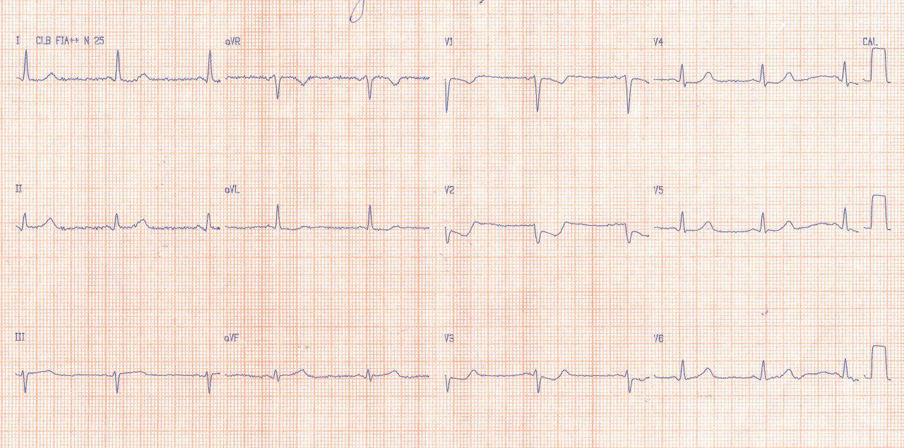 Mujer de 71 años con angor prolongado y sudoración profusa por IAMCEST por oclusión de Cx que es angioplastiada