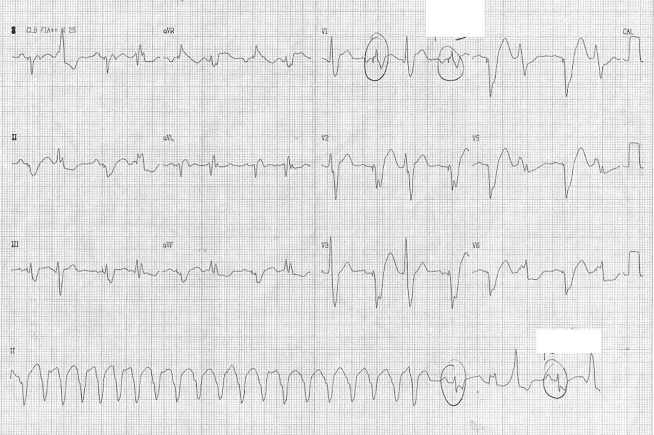 Mujer de 67 años portadora de miocardiopatía dilatada e implante de CDI que toma irregularmente su medicación que luego se optimiza