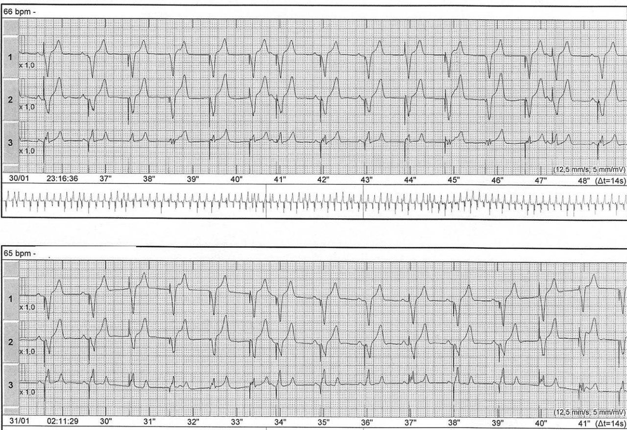Marcapasos VDD normofuncionante con pérdida de sincronismo AV por presencia de pausas sinusales