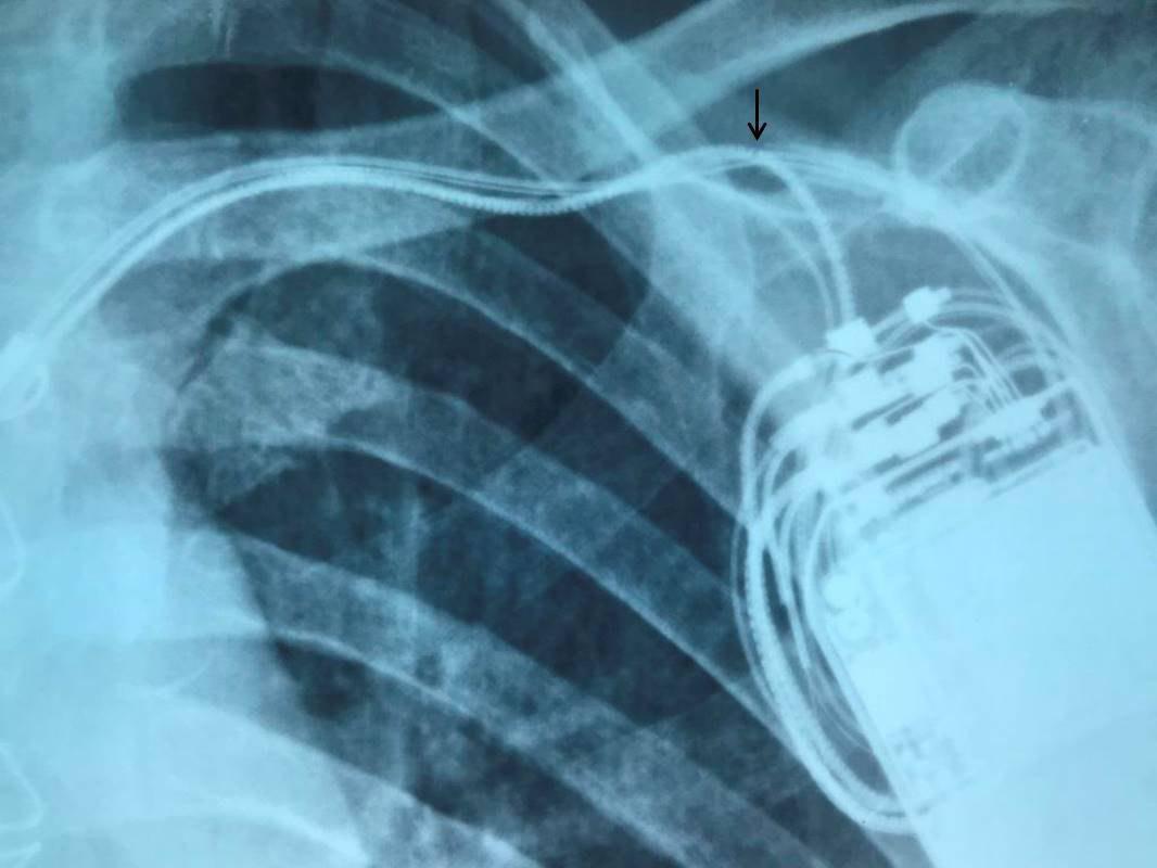 Paciente de 58 años con antecedente de IAM y CDI implantado que produce descargas espúreas por daño de la envoltura del cable