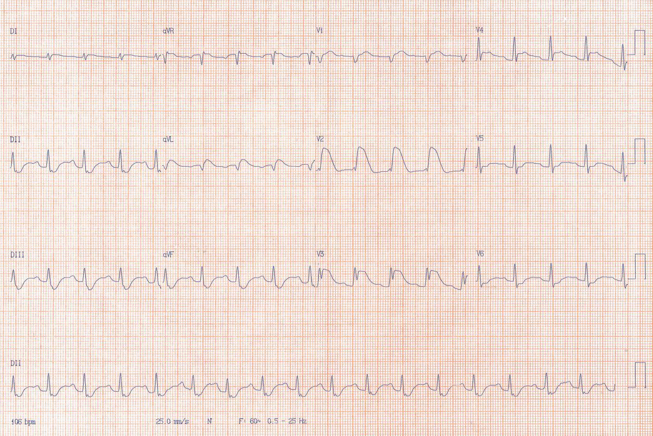 Paciente de 33 años tabaquista y dislipémico con angor de reciente comienzo desde hace 3 meses que presenta síncope convulsivo por FV