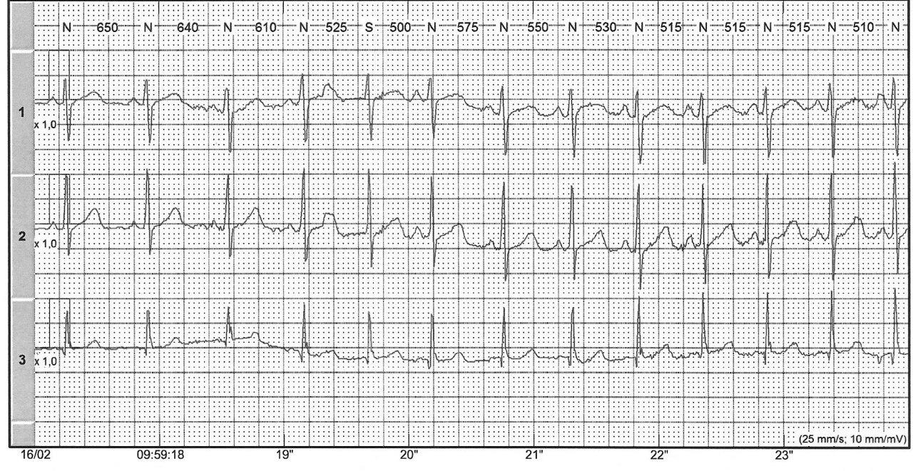 Mujer de 31 años con palpitaciones recurrentes por TRIN