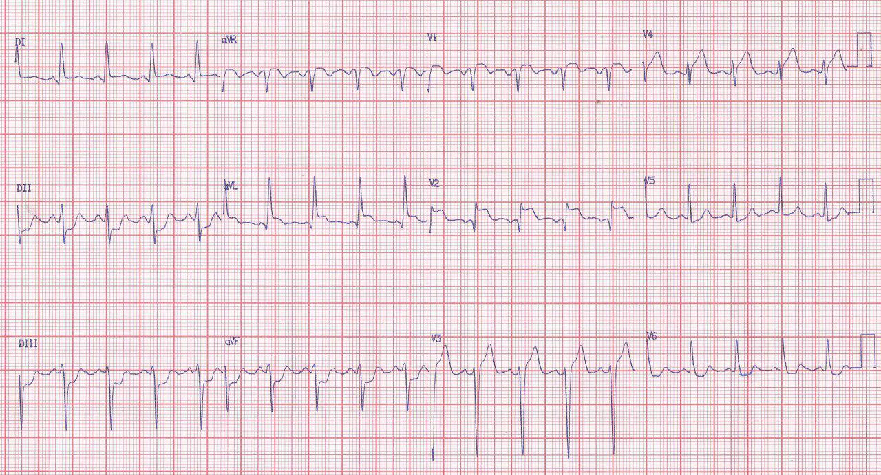 Paciente de 67 años con angor prolongado por compromiso de DA y Cx, hemodinámicamente compensado por la presencia de circulación colateral