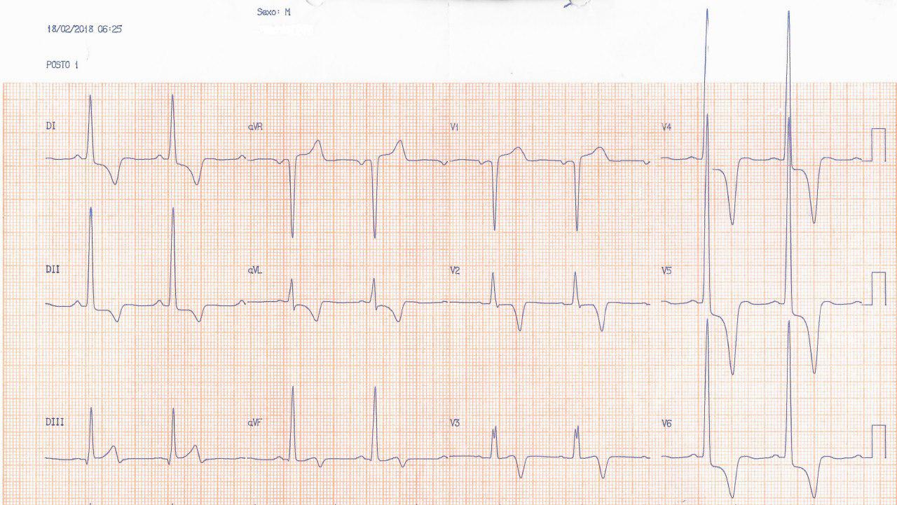 Paciente de 46 años con muy severa HVI por miocardiopatía hipertrófica obstructiva