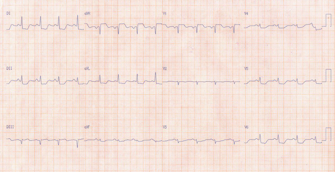 Mujer de 59 años con angor prolongado y EAP con ECG compatible con SCA que presenta estenosis aórtica severa