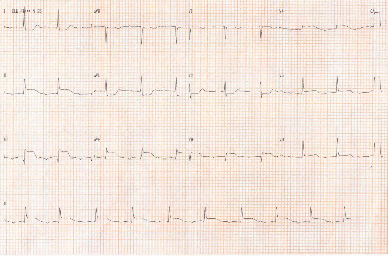 Mujer de 85 años con SCA por IAM inferior e infarto auricular