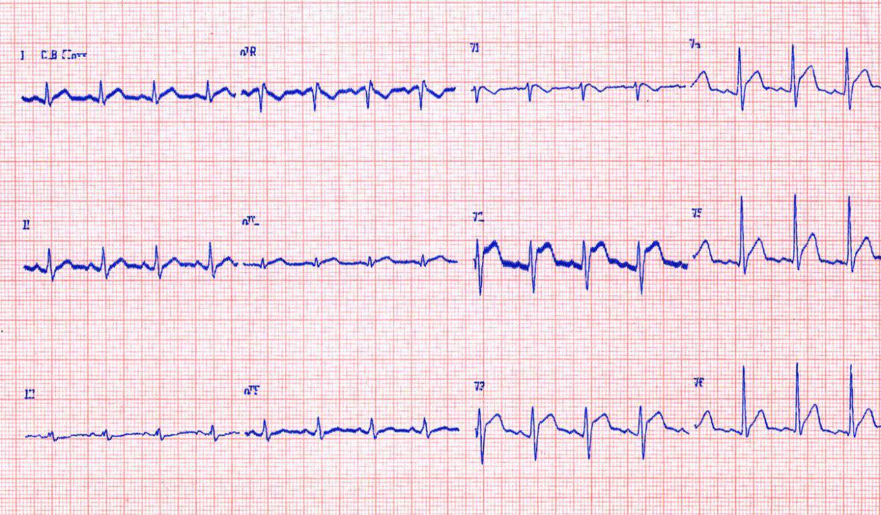 Paciente de 27 años que luego de consumo de cocaína presenta dolor precordial con CCG normal y fuerte sospecha de concomitancia con síndrome de Brugada