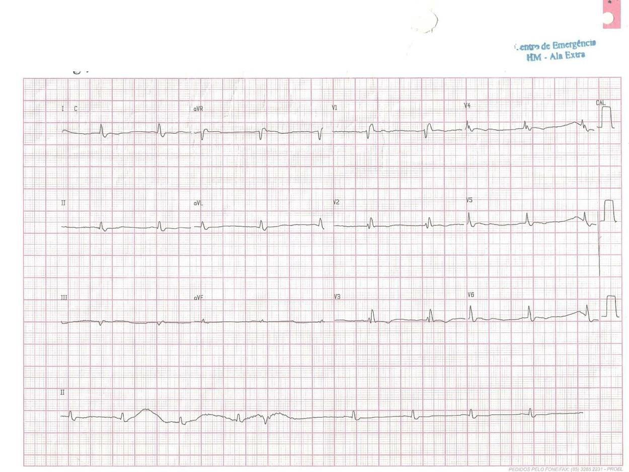 Paciente de 59 años chagásico con hipotiroidismo y anemia severa que presenta angor y disnea por enfermedad coronaria multivaso