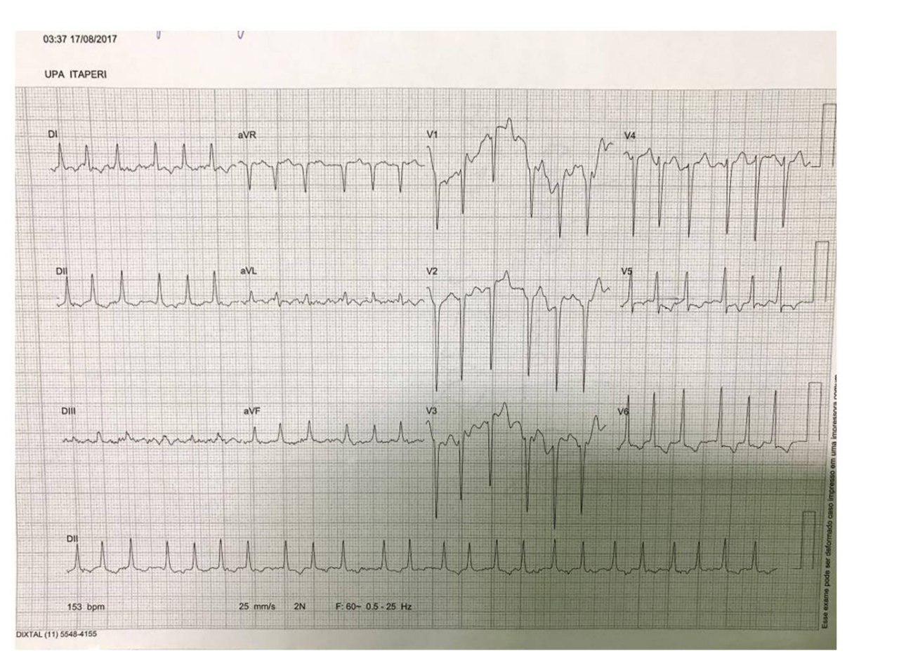Paciente de 40 años que presenta FA de alta respuesta que desarrolla taquimiocardiopatía que revierte luego de tratamiento con mapeo y ablación