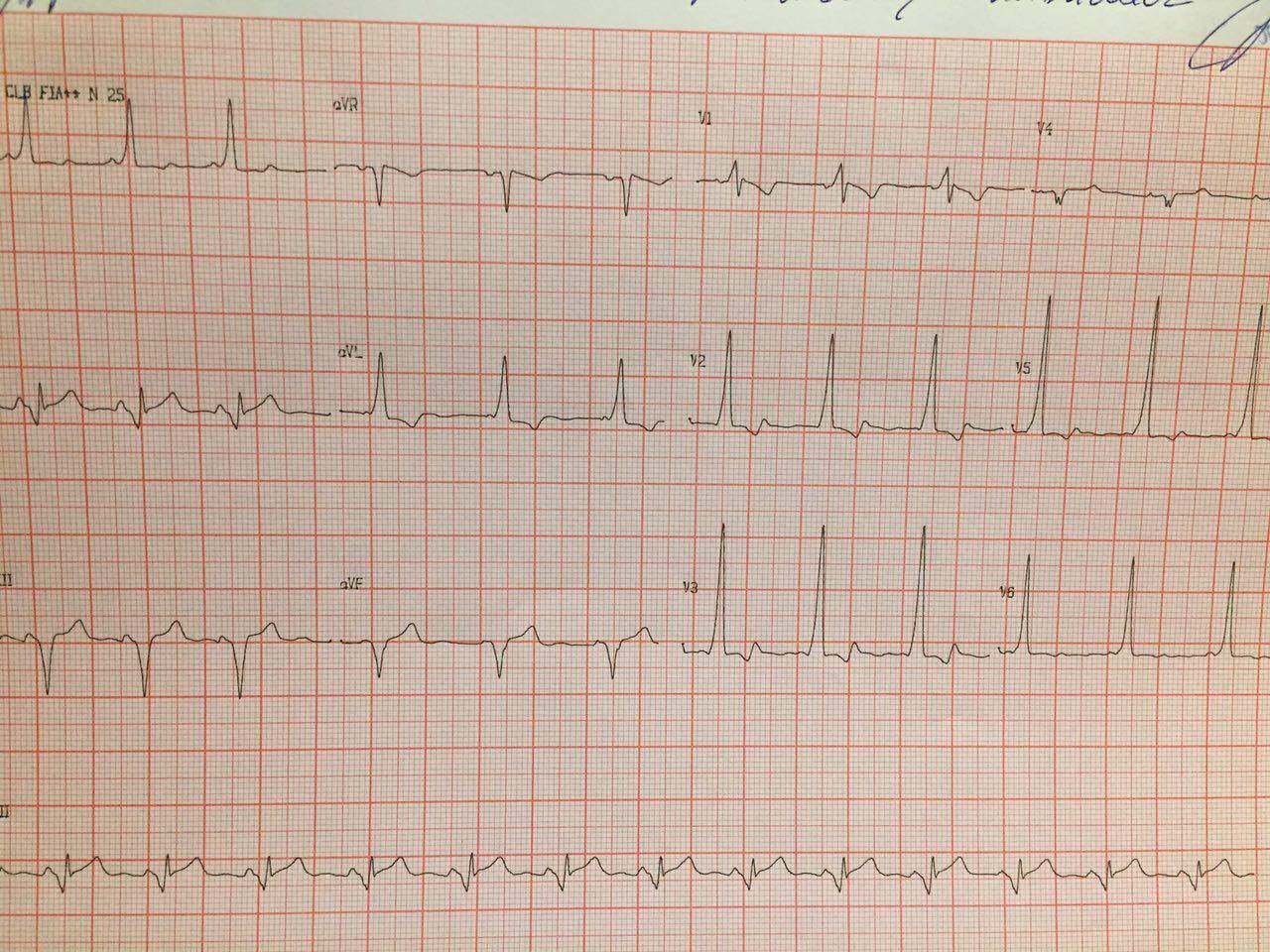 Masculino de 22 años con vía anómala póstero septal izquierda que se ablaciona con posterior recidiva